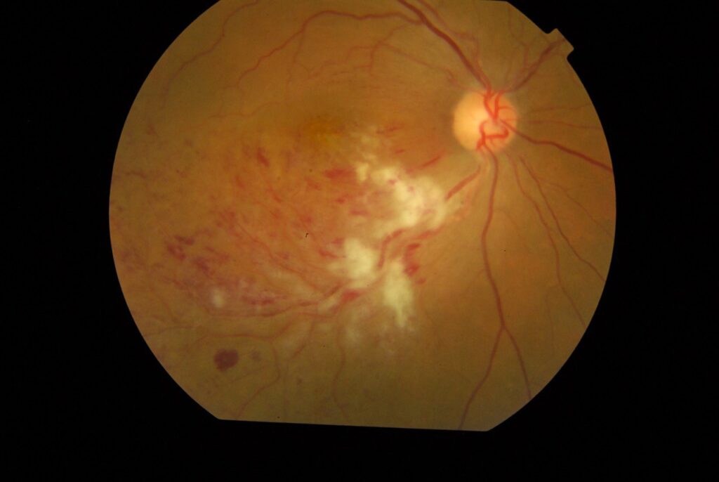 Şaxə retinal vena tıxanması