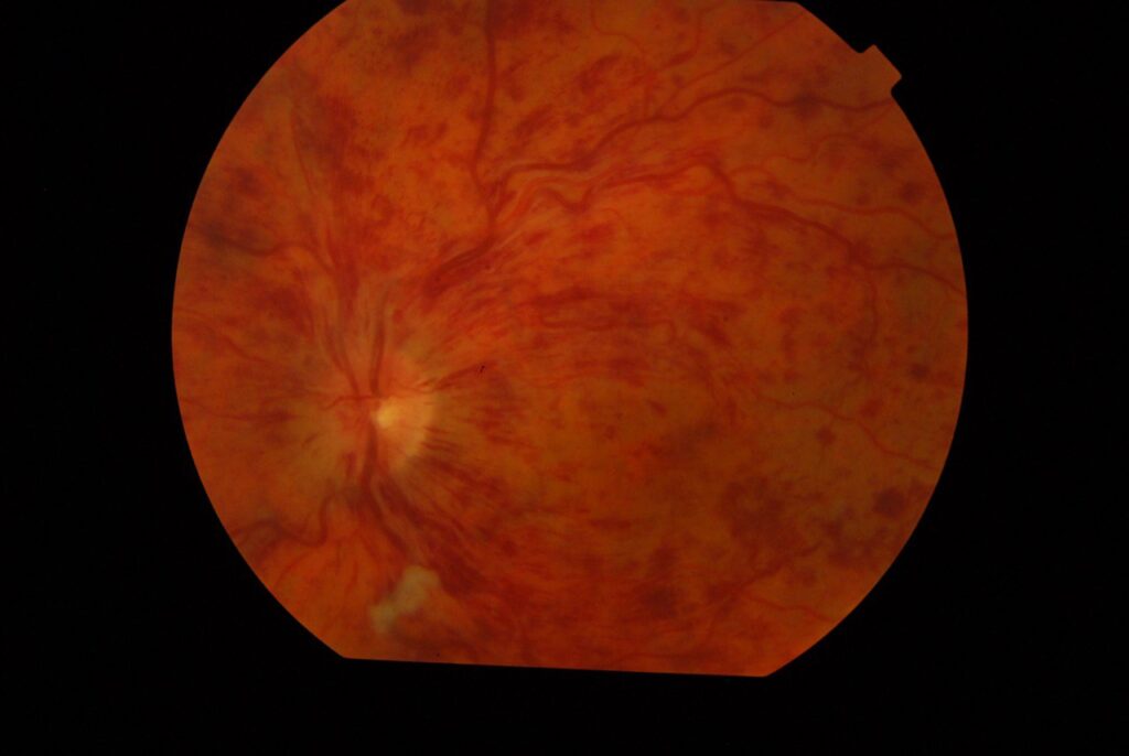 Mərkəzi retinal vena tıxanması